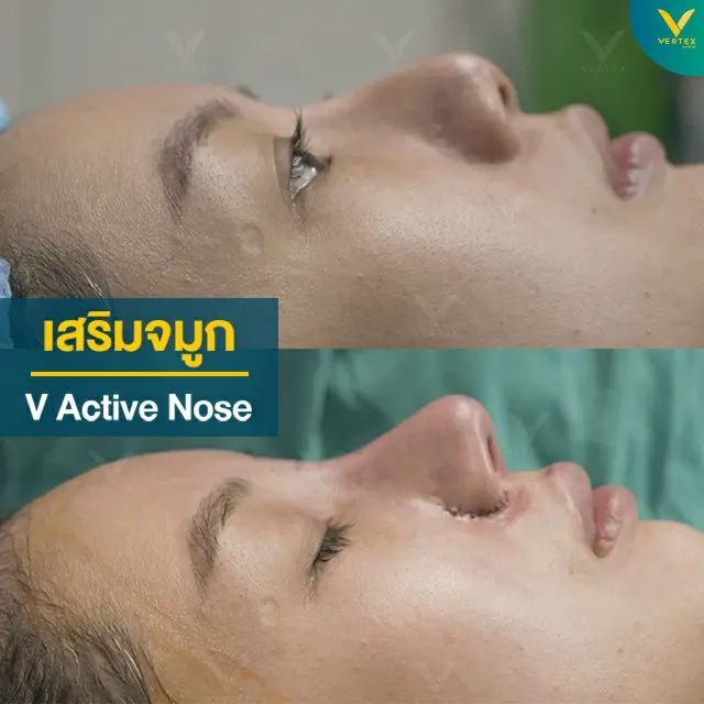 Nose-Surgery-Silicone-Before-After
