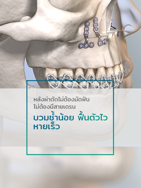 การผ่าตัดขากรรไกรแบบไม่ต้องมัดฟัน บวมน้อย ฟื้นตัวไว