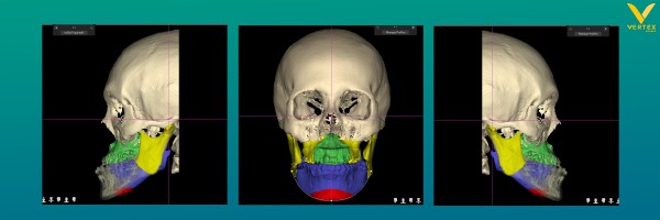 ภาพ CT Scan หลังจากผ่าตัดขากรรไกร