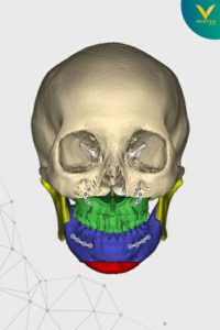 ภาพ CT Scan หมุดขากรรไกรของคนไข้จริง Vertex Clinic