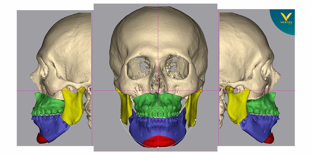 ภาพ CT Scan หลังจากผ่าขากรไกร ของ Vertex Clinic ใช้เทคนิค Nemotec V