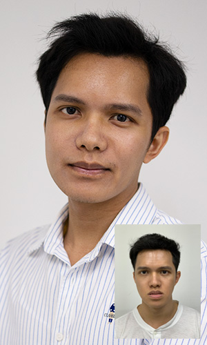 เปรียบเทียบก่อนและหลังผ่าขากรรไกร คุณอธิวัฒน์