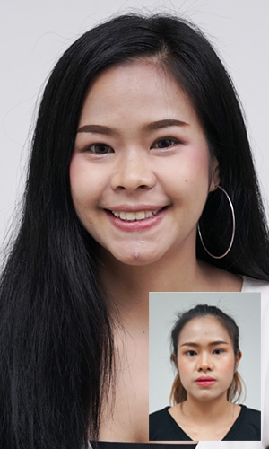 เปรียบเทียบก่อนและหลังผ่าขากรรไกร คุณจินตหรา