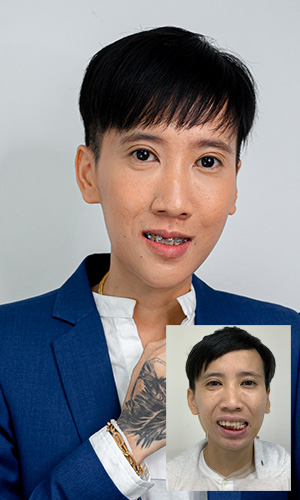 เปรียบเทียบก่อนและหลังผ่าขากรรไกร คุณจิรวรรณ