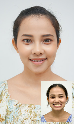เปรียบเทียบก่อนและหลังผ่าขากรรไกร คุณประไพมาศ