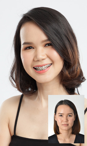 เปรียบเทียบก่อนและหลังผ่าขากรรไกรของคุณรุจี