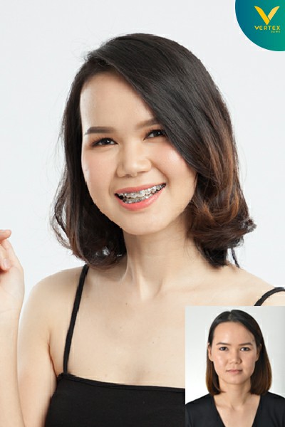 เปรียบเทียบก่อนและหลังผ่าขากรรไกร คุณรุจี