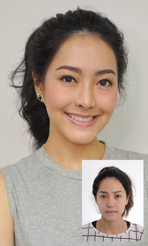 เปรียบเทียบก่อนและหลังผ่าขากรรไกร คุณศวิตา