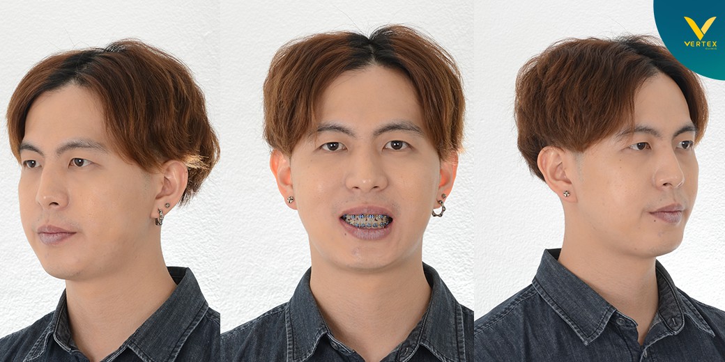เปรียบเทียบก่อนและหลังผ่าขากรรไกร คุณยศกร