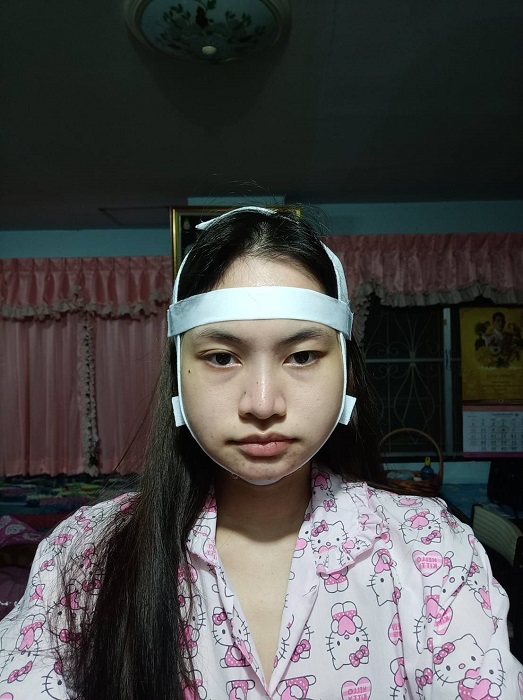 วันที่ 2 หลังผ่าตัดกราม และกลับบ้าน ถอดผ้าแล้ว
