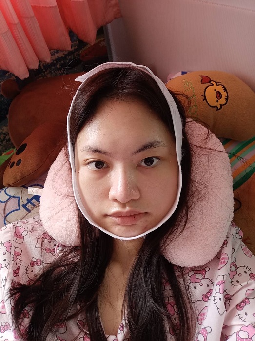 วันที่ 3 หลังผ่าตัดกราม หน้ายังคงบวม แต่น้อย