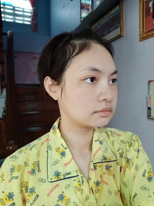 วันที่ 4 หลังผ่าตัดกราม หน้ายังคงบวม มีความละมุนมากขึ้น