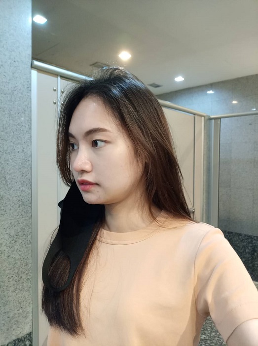 วันที่ 9 หลังผ่าตัดกราม รู้สึกว่าใบหน้าเล็กกว่าเดิม เริ่มเข้าที่มากยิ่งขึ้น ภาพมุมซ้าย