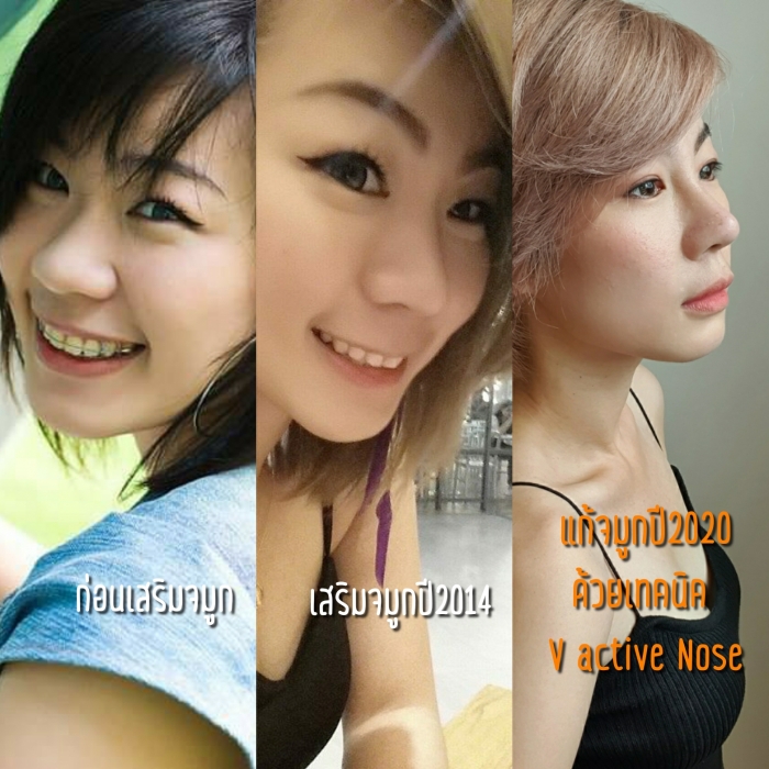 ภาพก่อนและหลังทำจมูกตั้งแต่ครั้งแรกจนถึงปัจจุบัน