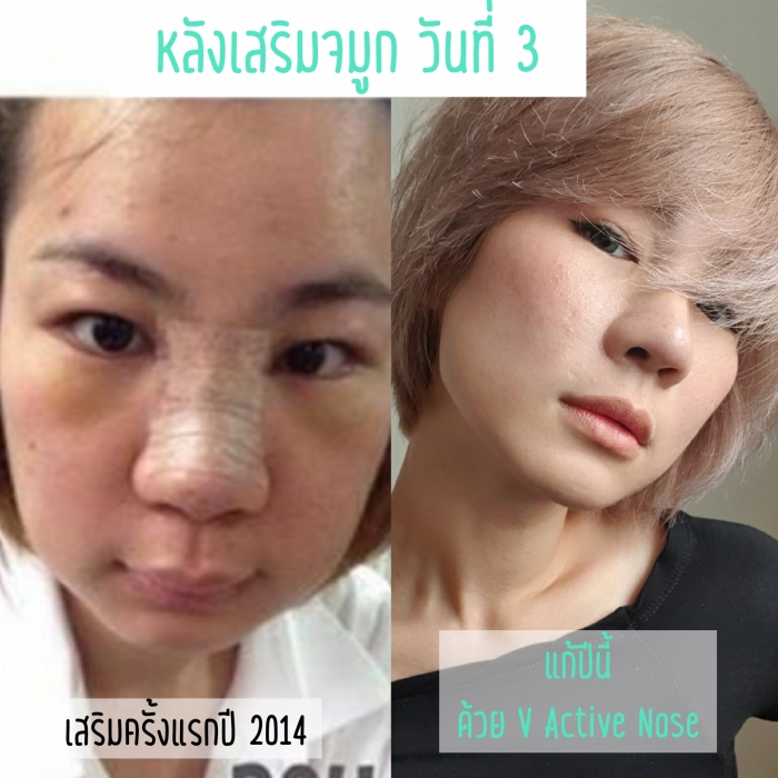 ภาพเปรียบเทียบเสริมจมูกครั้งแรก และแก้จมูกด้วย V Active Nose