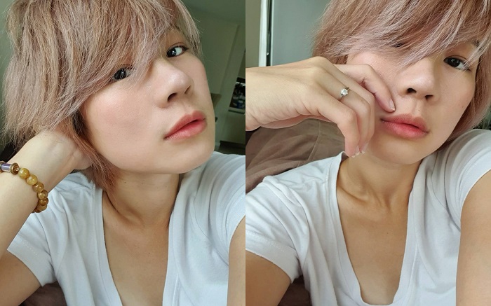 หลังทำการแก้จมูก วันที่ 5 สวยมาก จมูกสวยขึ้นทุกวัน