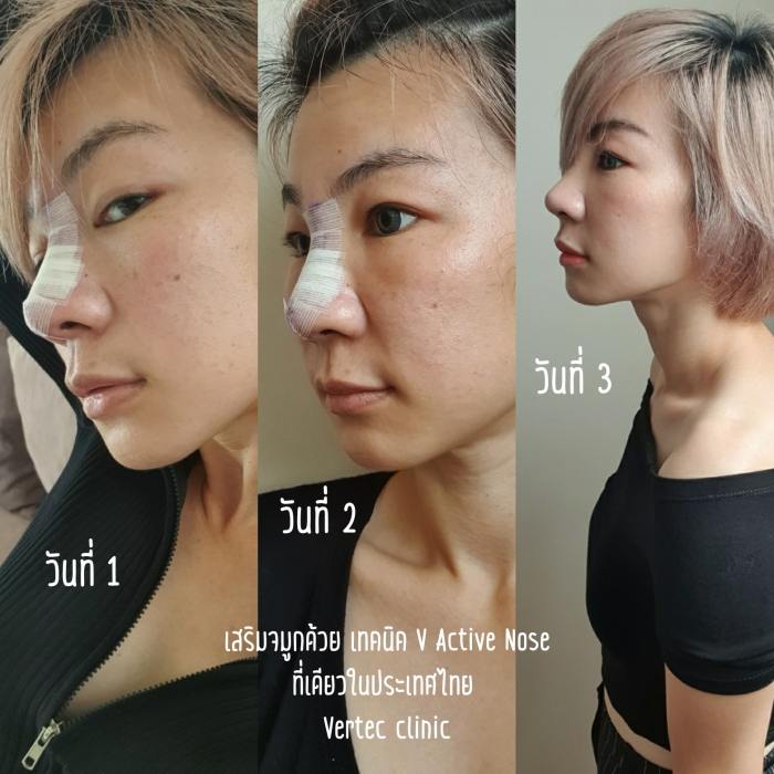 หลังจากทำจมูก ตั้งแต่วันที่ 1-3