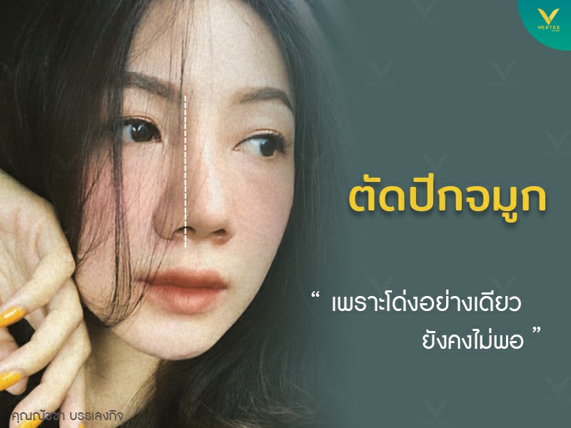 ทำจมูก แก้จมูก ผ่าตัดปีกจมูก คุณณัชชา คนไข้จริง