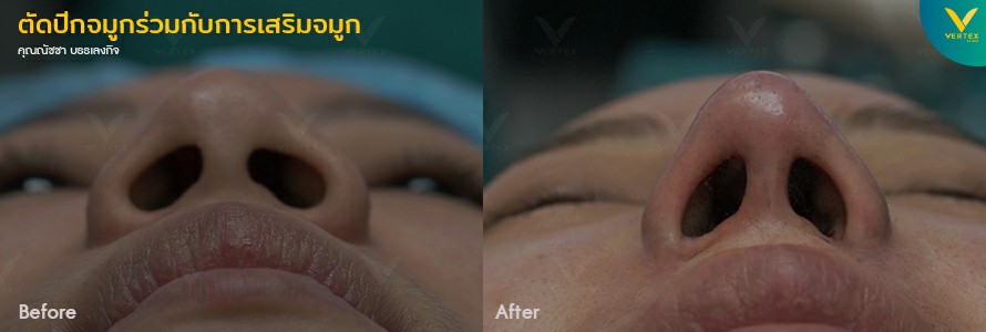 เปรียบเทียบก่อนหลังทำจมูก แก้จมูก ผ่าตัดปีกจมูก มุมเงย