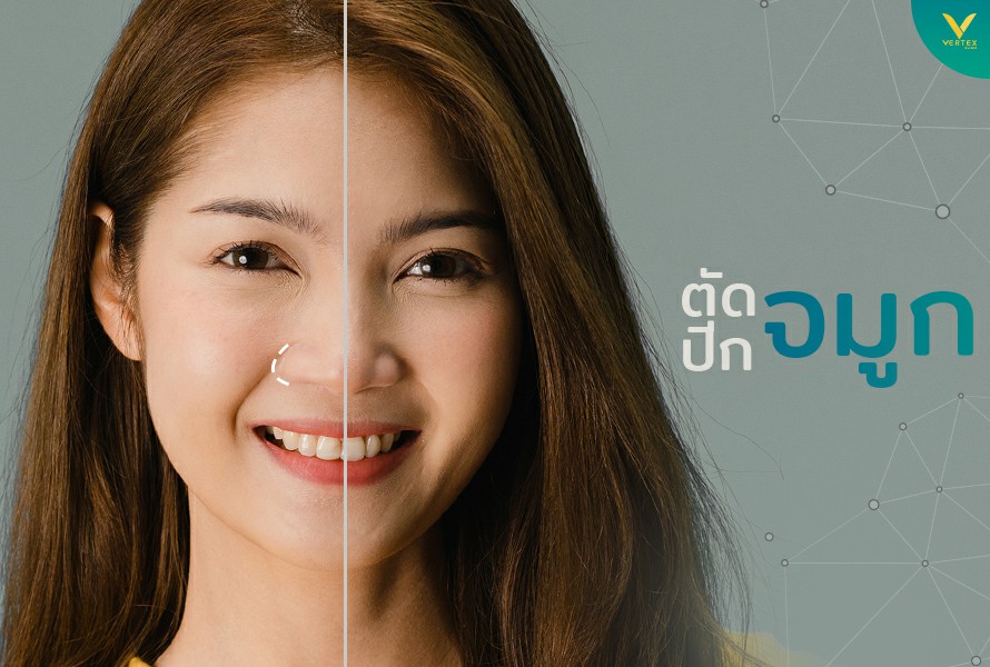 ตัดปีกจมูก