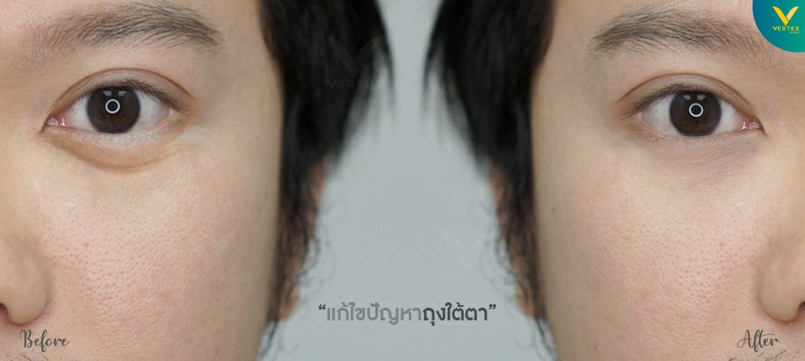 ภาพตัวอย่างการแก้ไขปัญหาถุงใต้ตาเยอะ
