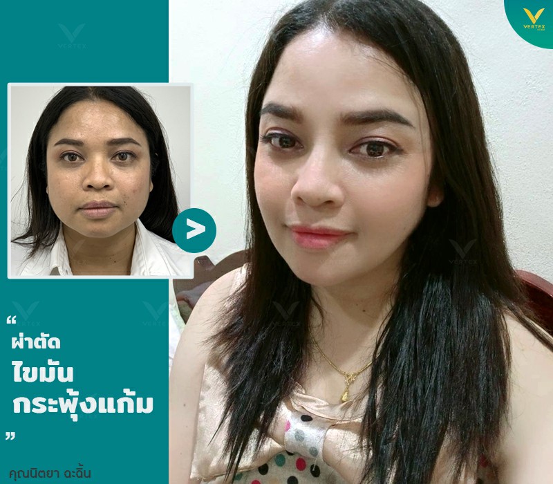 คุณนิตยา ผ่าตัดไขมันกระพุ้งแก้ม ตัดไขมันแก้ม ลดแก้มถาวร
