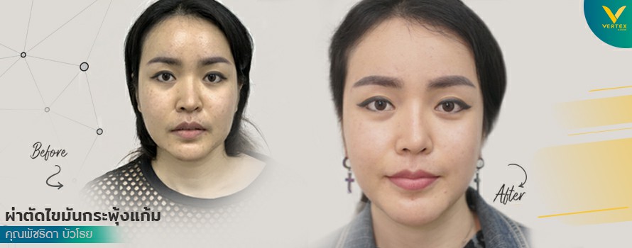 คุณพัชริดา ผ่าตัดไขมันกระพุ้งแก้ม ตัดไขมันแก้ม ลดแก้มถาวร