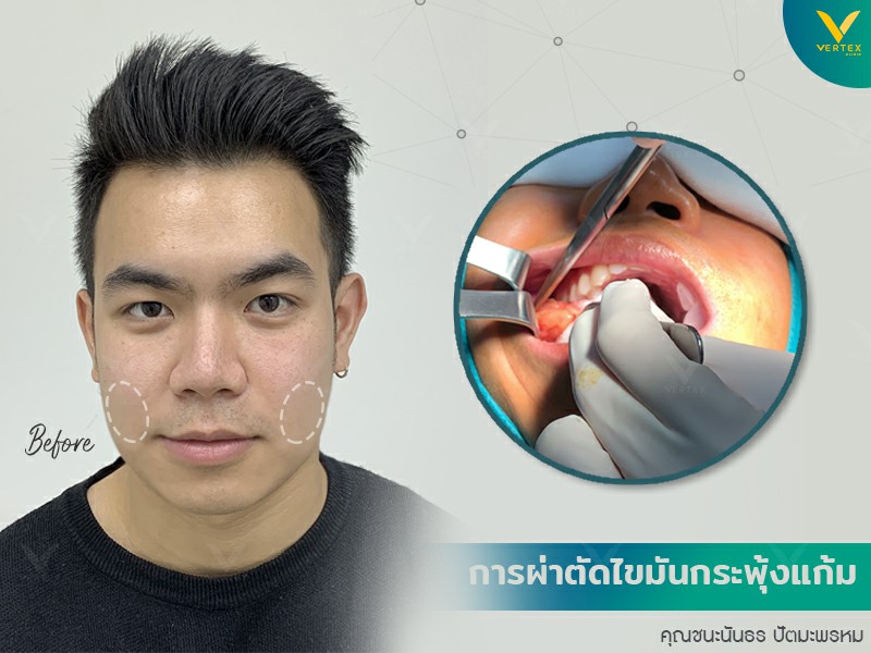 ภาพแสดงไขมันกระพุ้งแก้ม ไขมันแก้มเยอะ ตัดไขมันแก้ม