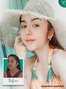 รีวิวเสริมหน้าแก้ม เสริมโหนกแก้ม เพิ่มหน้าแก้มด้วย Biopolymer คุณจุฑารัตน์