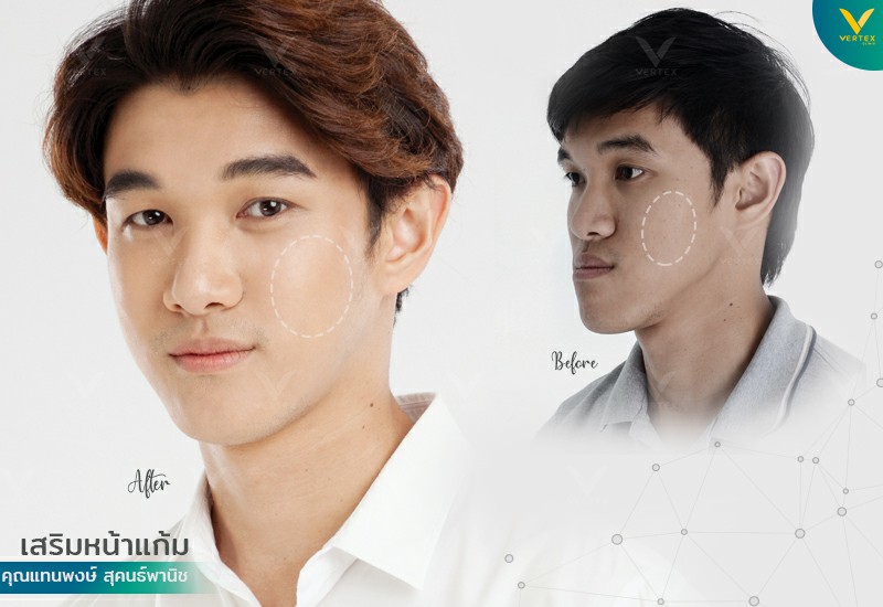รีวิวเสริมหน้าแก้ม เสริมโหนกแก้ม เพิ่มหน้าแก้มด้วย Biopolymer คุณแทนพงษ์