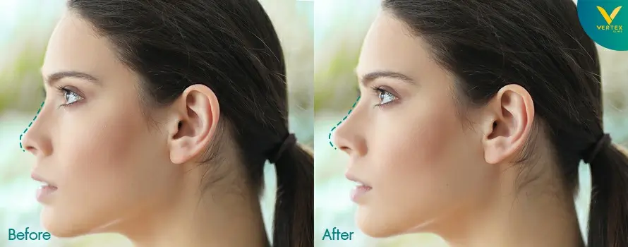 Compare_Open-Rhinoplasty