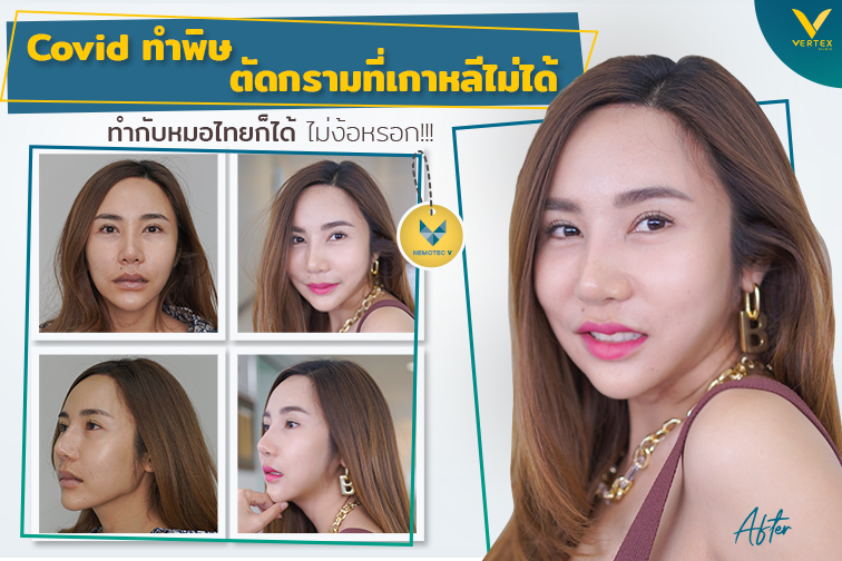 [รีวิวตัดกราม]โควิดทำพิษศัลยกรรมกรามเกาหลีไม่ได้ตัดกรามกับหมอไทยก็ได้ไม่ง้อหรอก!