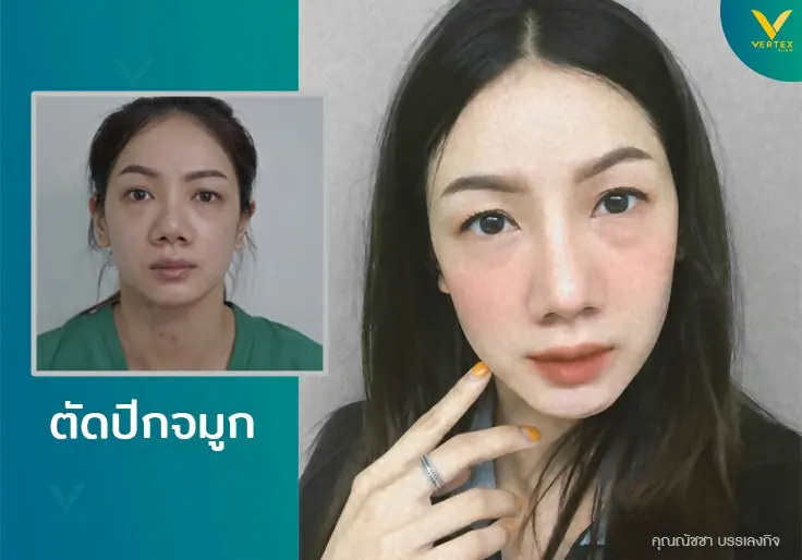 Nose-Alarplasty-Natcha
