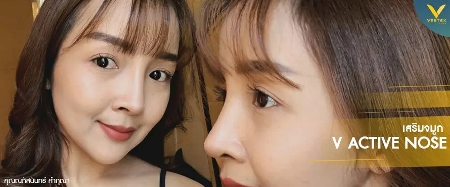 Nose-Surgery-Review-Nuch