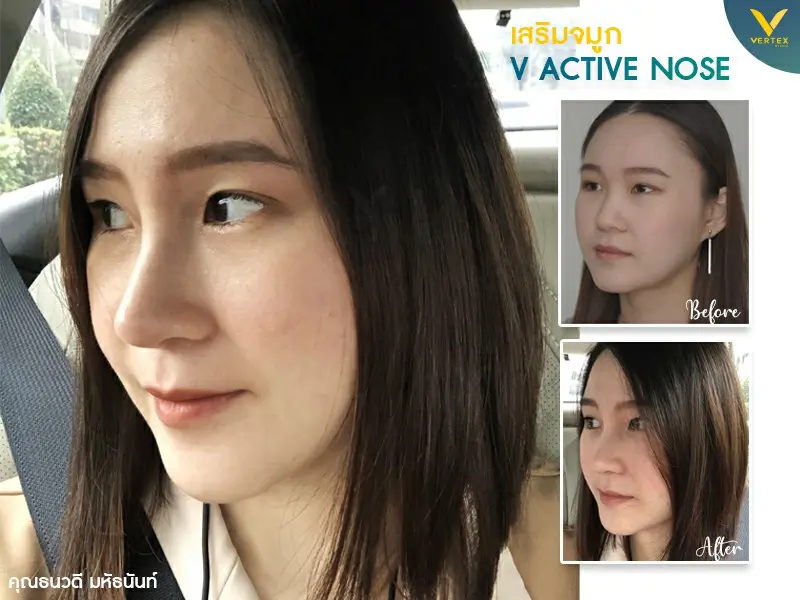 Nose-Surgery-Review-Thanawadee