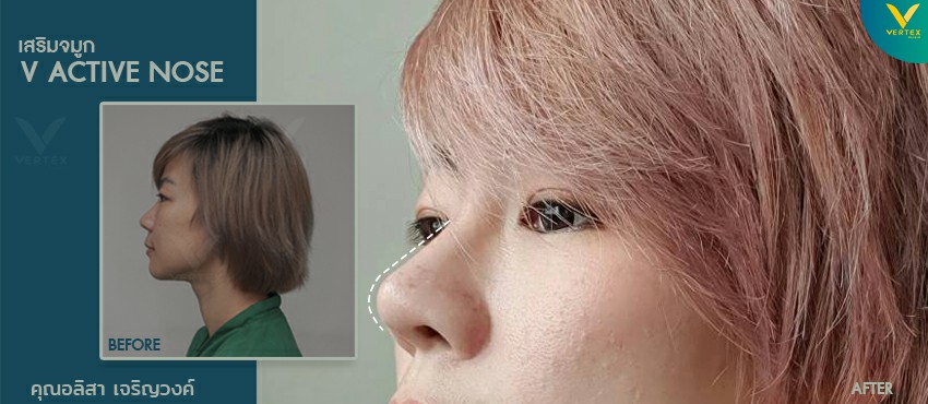 ศัลยกรรมจมูก รีวิวแก้จมูกของคุณอลิสา