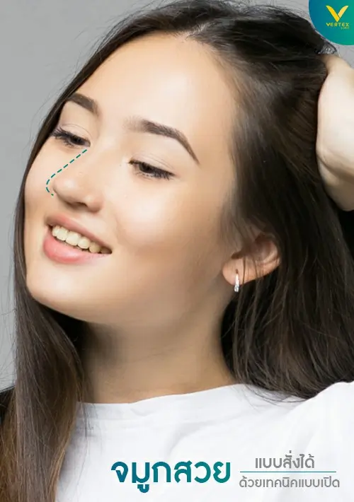 Open-Rhinoplasty
