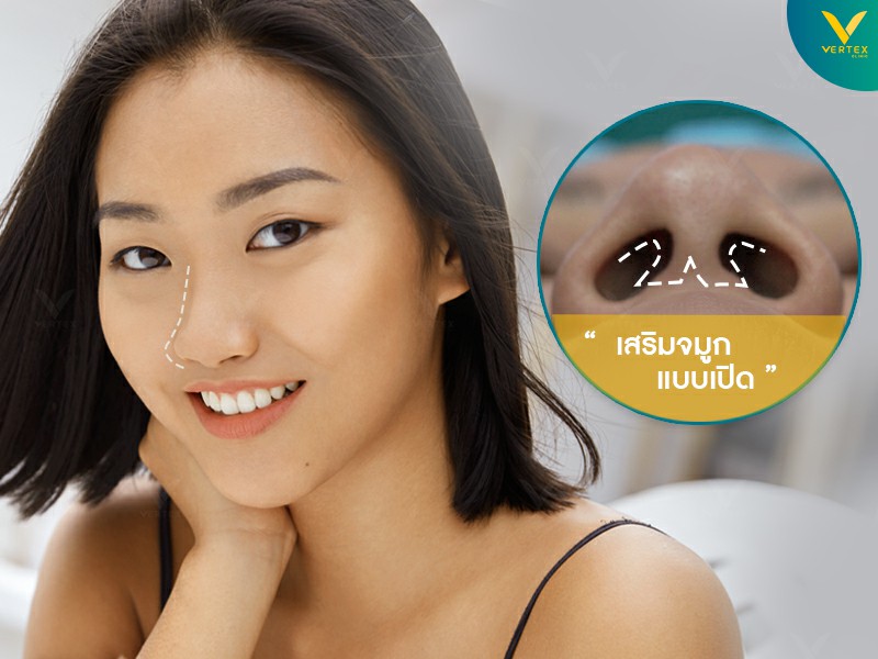 ทำจมูกเทคนิคโอเพ่นหรือเสริมจมูกแบบเปิด