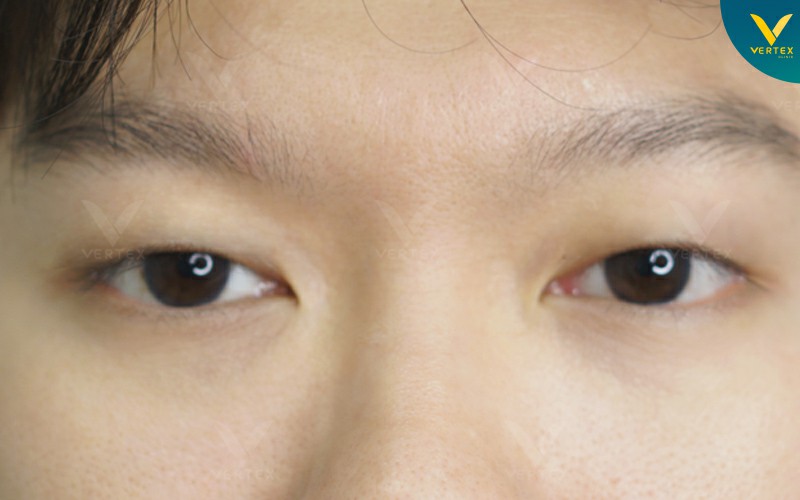 แก้ไขกล้ามเนื้อตาอ่อนแรง