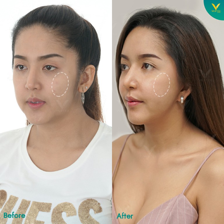 Review-Cheek-Biopolymer