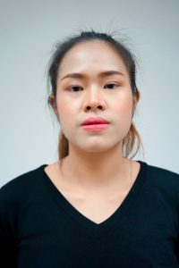 รีวิวหน้าก่อนตัดโหนก ตัดกราม ผ่าขากรรไกร คุณจินตหรา