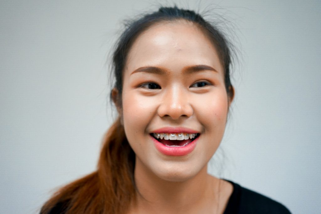 รีวิวภาพเวลายิ้ม ก่อนตัดโหนก ตัดกราม ผ่าขากรรไกร คุณจินตหรา