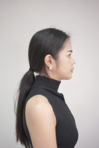 รีวิว 6 เดือนผ่านไป มุมด้านข้าง หลังตัดโหนกแก้ม ผ่าขากรรไกร ตัดกราม