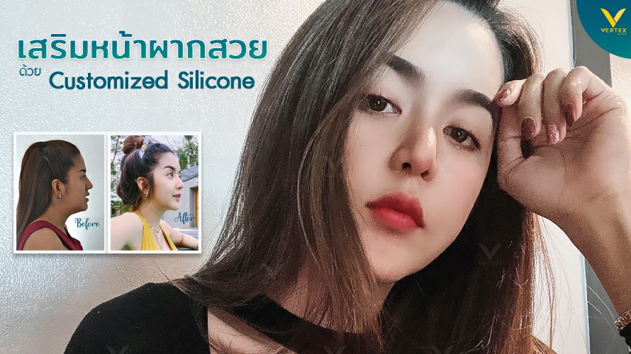 ภาพรีวิวคุณจุฑารัตน์ ทำหน้าผากและเสริมหน้าผากด้วยซิลิโคน