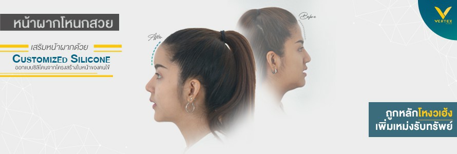 รีวิวเสริมหน้าผากด้วยซิลิโคนเฉพาะบุคคล คุณจุฑารัตน์