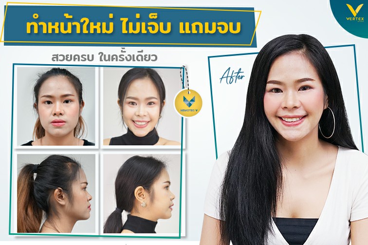 [รีวิวผ่าขากรรไกร+ตัดโหนก+ตัดกราม] ไม่เจ็บแถมจบ สวยครบในครั้งเดียว