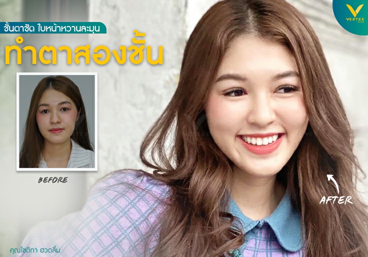 ศัลยกรรมตา ทำตาสองชั้น