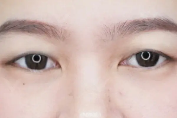 Eye-Surgery-Problem