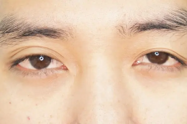 Eye-Surgery-Problem
