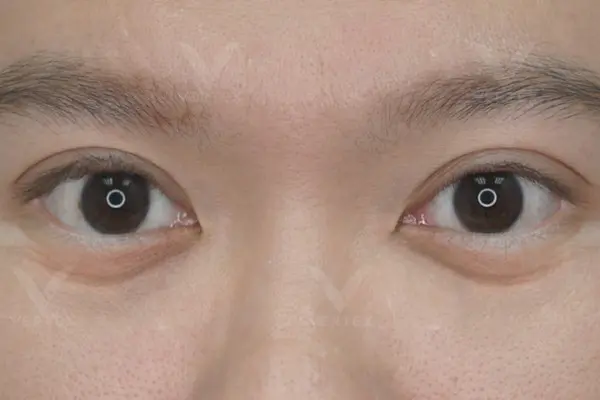 Eye-Surgery-Problem